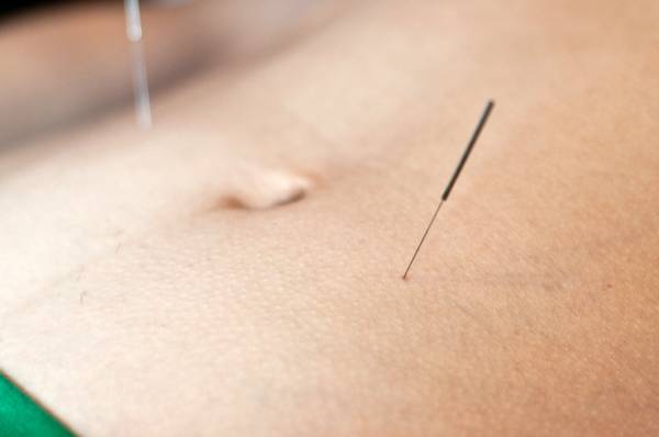 Using acupuncture to attain weight loss became popular in 2003 when CNN reported success stories from weight loss clinics in China. (wikimedia)