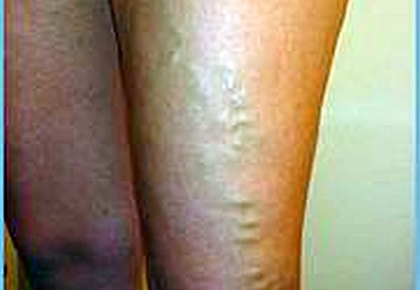 Spider veins are like varicose veins but they are much smaller. (wikimedia)