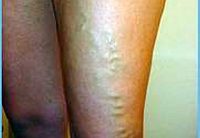 Spider veins are like varicose veins but they are much smaller. (wikimedia)